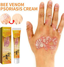 Crème Psoriasis Kaluofan Dabeille - Traitement Efficace