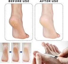 BLeezm Grattoir pour le Nettoyage des Callosités - Corne Pied