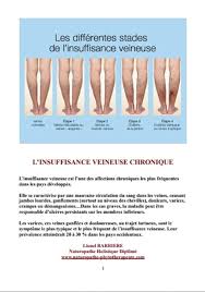 Soulagement des Jambes Lourdes : Comprendre l'Insuffisance Veineuse Chronique