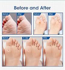 Facyn24 Tampons Orteils pour Soulager les Cors aux Pieds