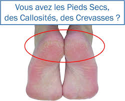 Râpe Lime Pédicure Anti Callosités - Soin Optimal pour Vos Pieds
