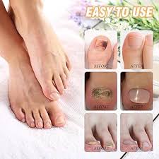 Pansement Comprimés pour Ongles de Pieds - Soin Efficace