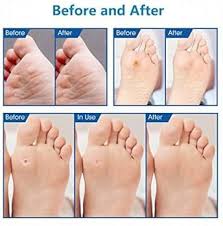 Pansements Anti Verrues pour Callosités - Protection et Confort