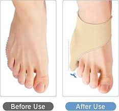 Correcteur de Bunionette - Soulagement et Confort