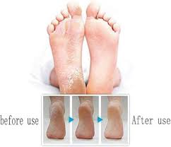 Grattoir Pédicure pour Callosités - Soin Optimal pour Vos Pieds