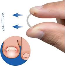 Young21 Redressement Correction pour Ongles Incarnés - Soins Spécialisés