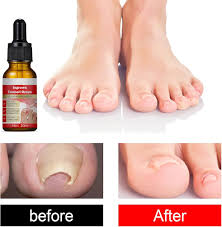 Traitement Ongles Incarnés: Solution Efficace pour Vos Ongles