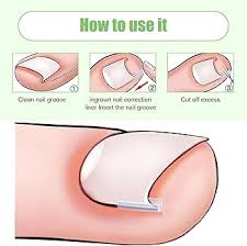 Ensemble Correction Correctrices pour Ongles Incarnés - Soulagement et Soins