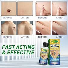 K KIECHEL Azote Liquide Anti Verrues - Solution Efficace pour Éliminer les Verrues